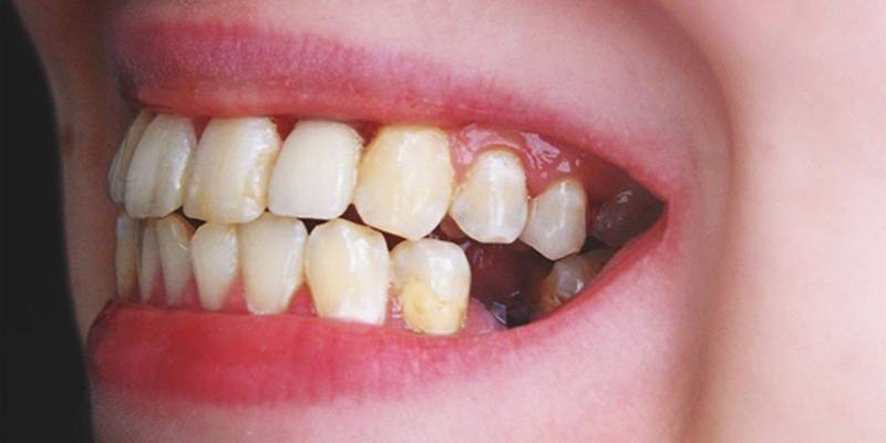 Các trường hợp cụ thể về giấc mơ thấy rụng răng