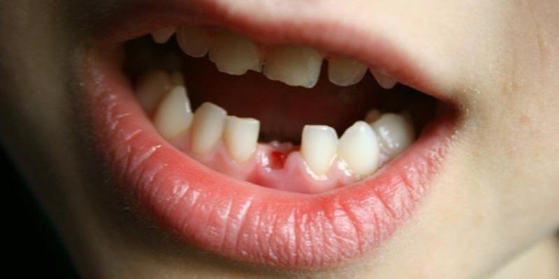 Ý nghĩa và nguyên nhân xuất hiện mơ thấy gãy răng chảy máu